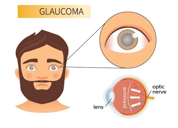 گلوکوم یا آب سیاه چیست ؟