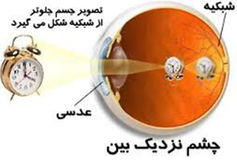 عیوب انکساری چشم