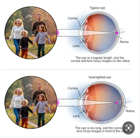 آیا می توان از ایجاد نزدیک بینی جلوگیری کرد