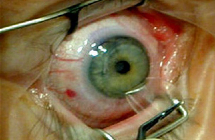 عوارض عمل لیزیک